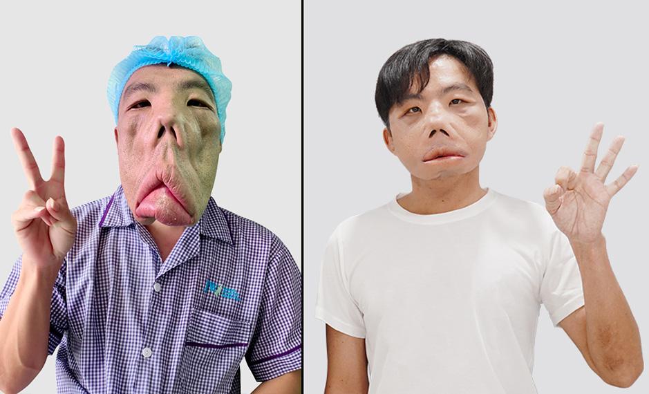 Người đàn ông mặt biến dạng xuất hiện chốn đông người, uống cafe cùng bác sĩ Tú Dung - Ảnh 2. Người đàn ông mặt biến dạng xuất hiện chốn đông người, uống cafe cùng bác sĩ Tú Dung - Ảnh 2.