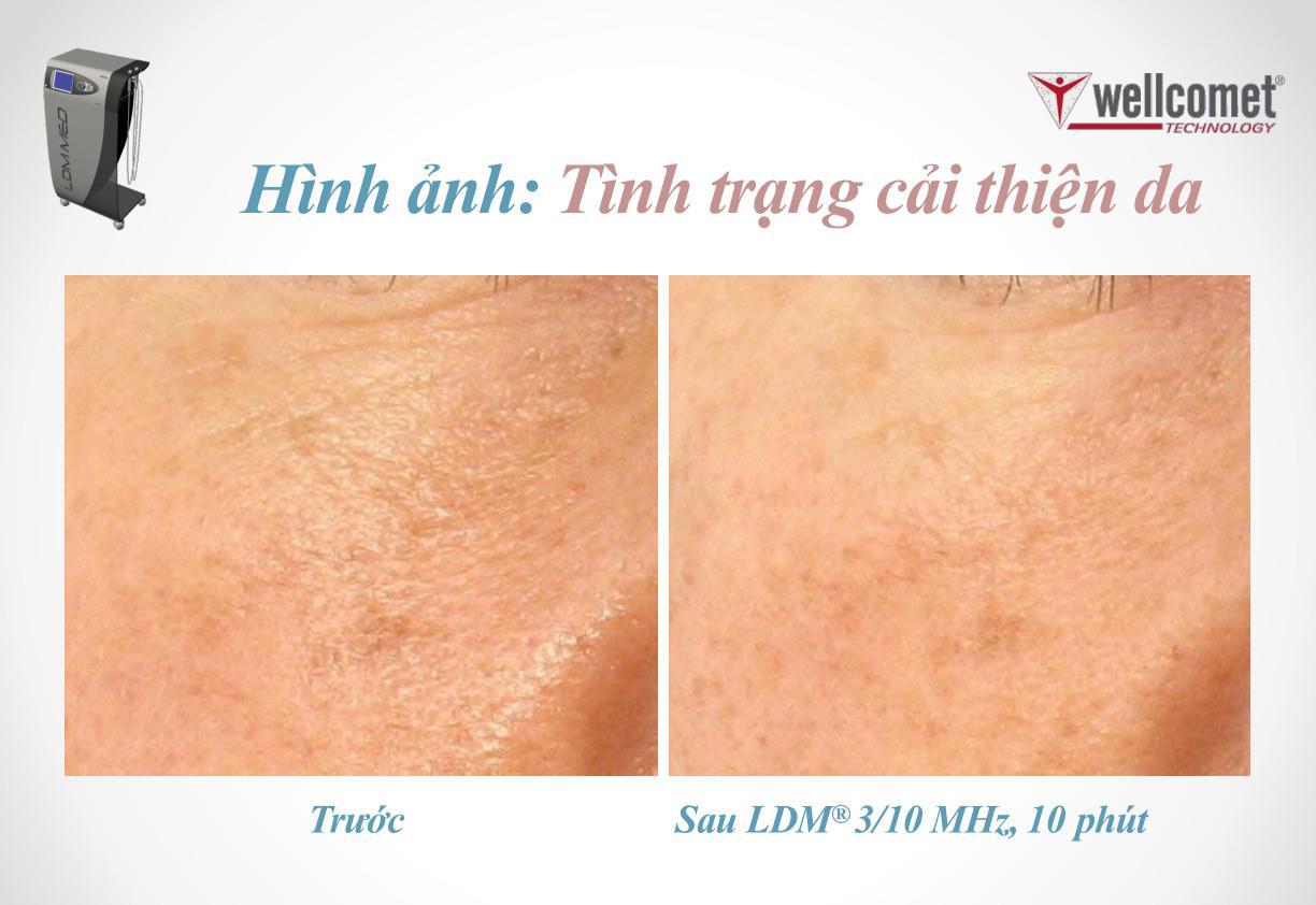 Tìm hiểu công nghệ LDM - Bước tiến mới của ngành thẩm mỹ cao cấp - Ảnh 3.