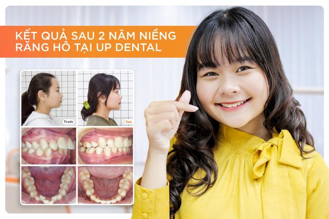 Sau khi tháo niềng, Phương Thùy “bóc phốt” Up Dental vì kết quả - Ảnh 2.
